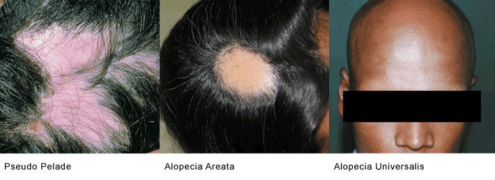 http://tamilsiddharnilayam.com/wp-content/uploads/2012/11/alopecia-areata-pseudo-pelade-alopecia-universalis